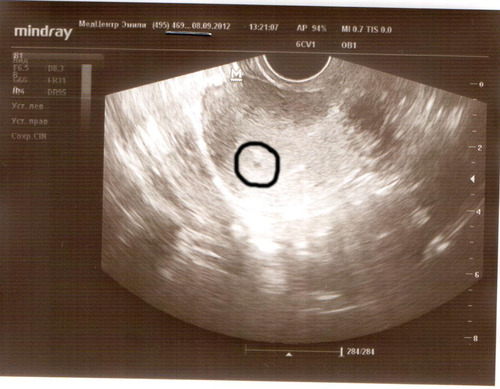 Как выглядит эмбрион на 4 неделе беременности (УЗИ)